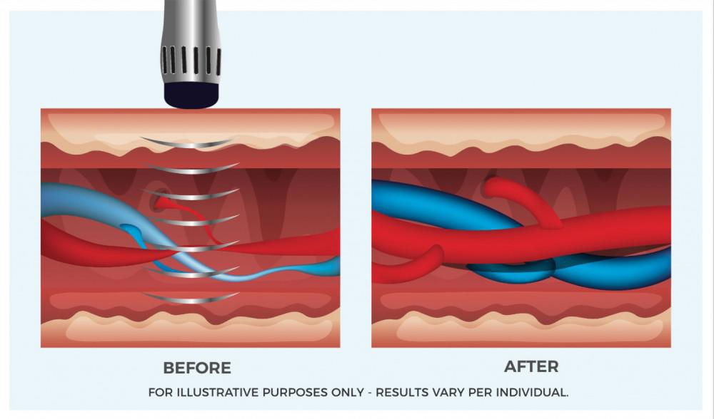 How Shockwave Therapy is Revolutionizing the Treatment of Erectile Dysfunction 6449ac3803880.jpeg